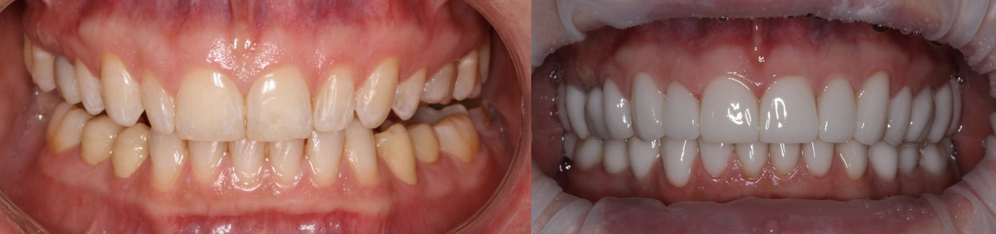 изменение формы зубов